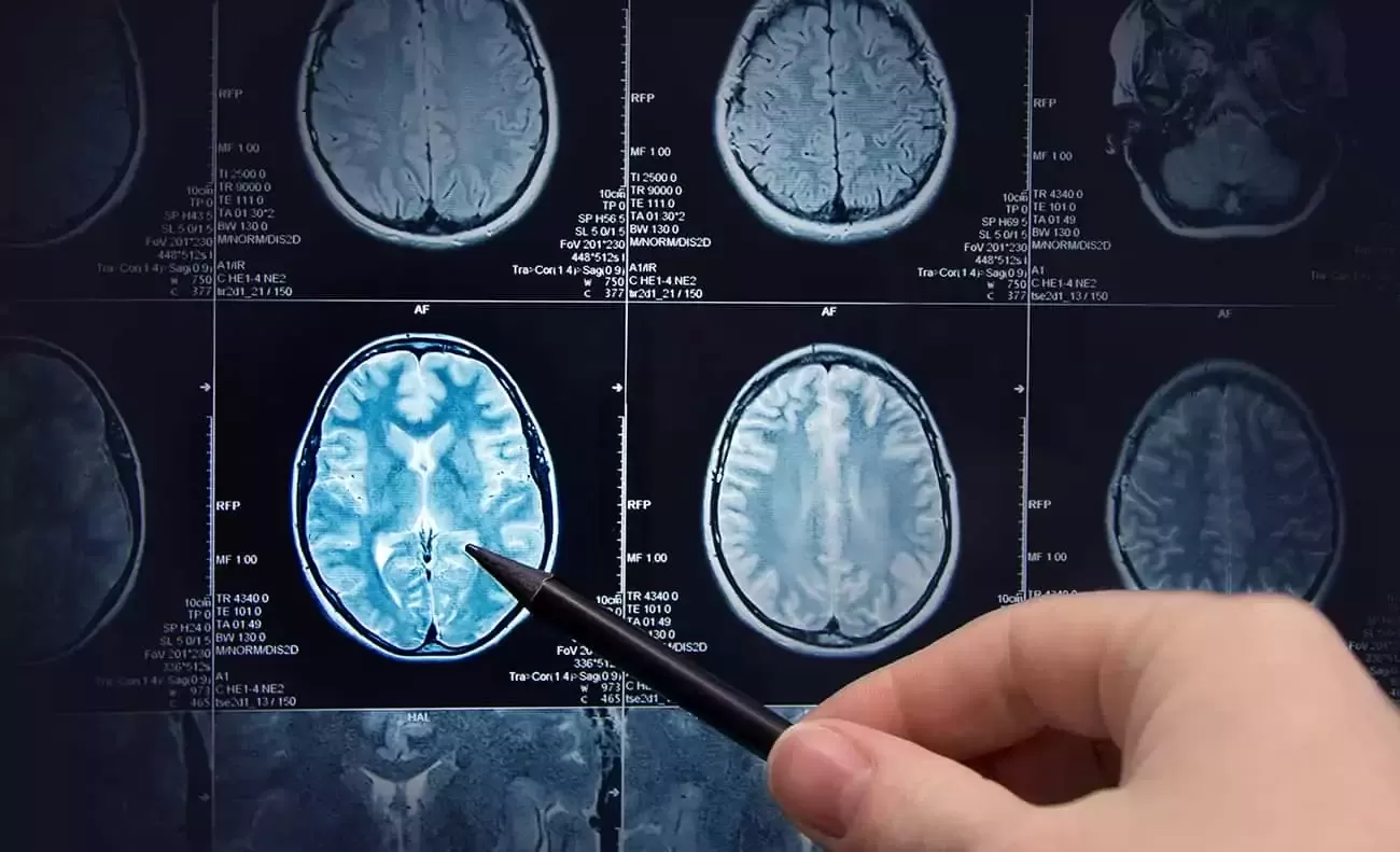 Numero de exames de imagem para esclerose multipla cresce 30 na rede publica