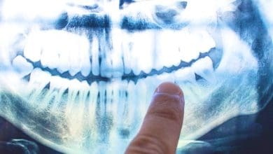 A causa da doenca de Alzheimer pode estar vindo de dentro de sua boca