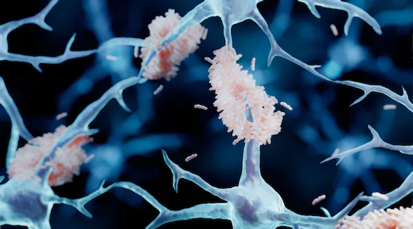 Diagnosticado o primeiro caso de Alzheimer em adolescente de 19 anos no mundo