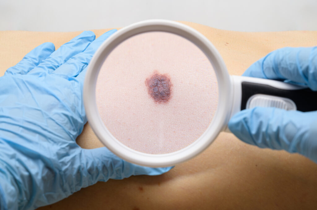 Tecnologia para tratar cancer de pele e aprovada para uso no SUS