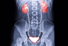 Realizado o primeiro transplante de bexiga humana no mundo